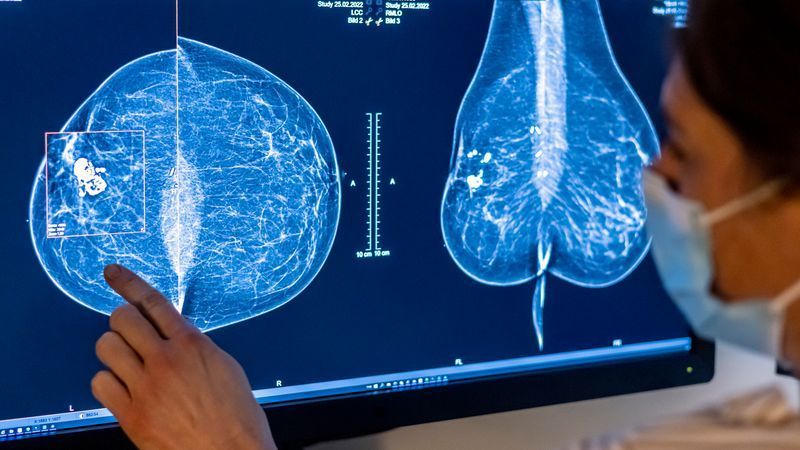 Mammographie-Screening in der Schweiz weiter empfohlen