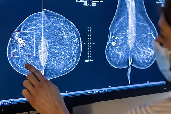 APA-Faktencheck: Nutzen der Mammografie weitaus größer als Gefahren - Featured image
