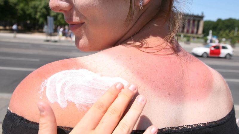 Sonnenbrand gab es bereits vor 100 Jahren - Featured image