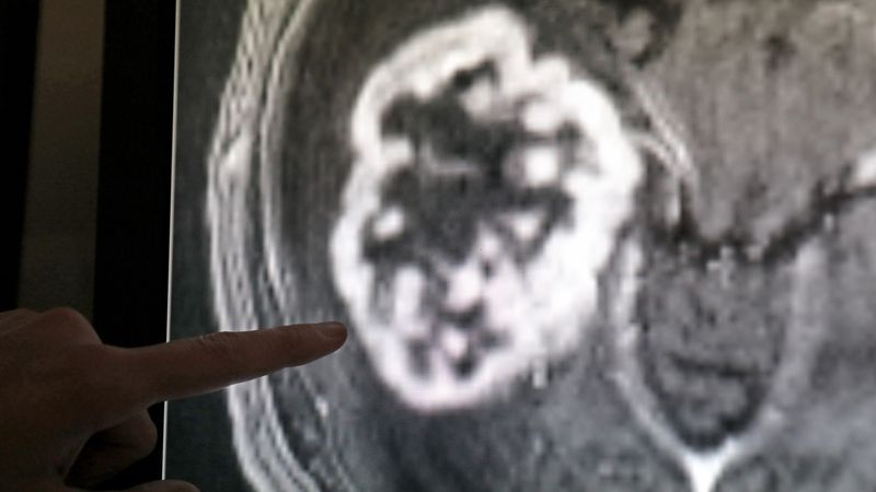 Südkoreanische Studie zu Krebsfällen falsch interpretiert - Featured image